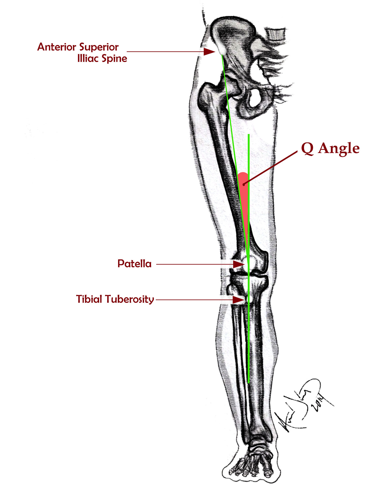 Figure 3.  The Q angle (quadriceps angle) is the angle formed by the intersection of two lines: the line from the middle of the patella to the anterior superior iliac spine (ASIS) and a line from the tibial tubercle through the middle of the tubercle. 