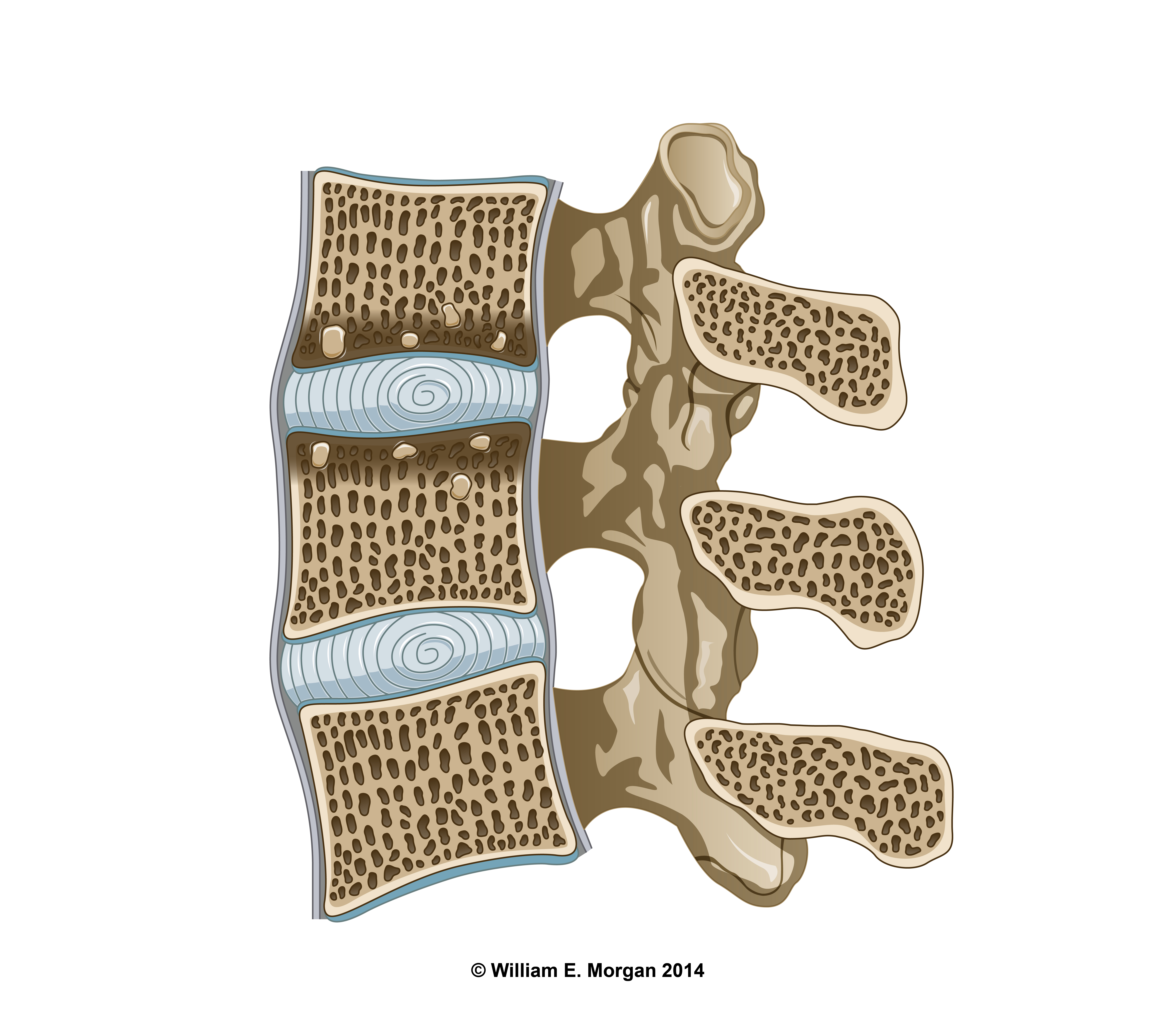 Sclerotic changes of the cortical bone and thickening of the endplates are indicative of Modic 3 changes. 
